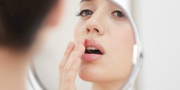 Uçuk Nasıl Geçer? Doğal Yollarla Uçuk Geçirme Yöntemleri